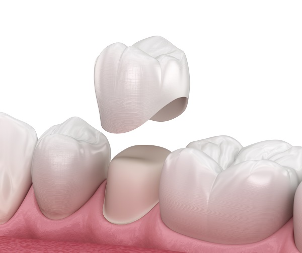 Commonly Asked Dental Crowns Questions