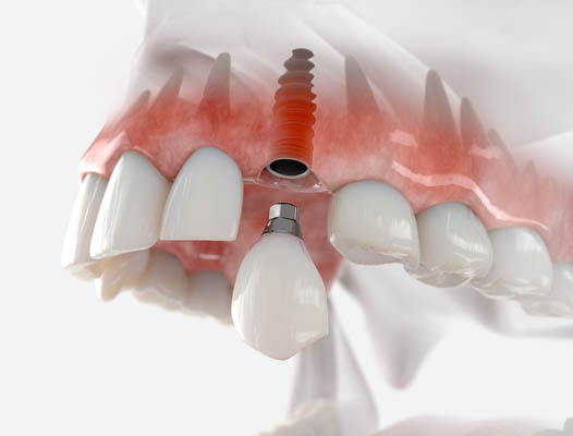 Dental Implant Jackson Heights, NY