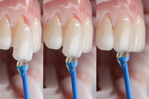 Popular Dental Veneers Materials