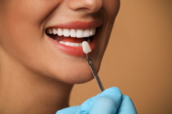 What Should I Do If I Damage My Dental Veneers?
